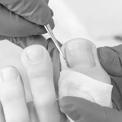 goolefootclinic-foot-treatment-N5-BW