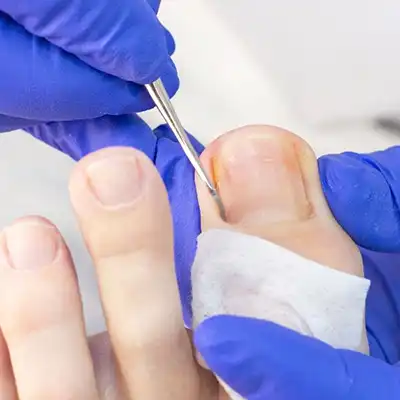 goolefootclinic-foot-treatment-N5