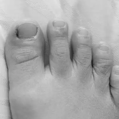 goolefootclinic-foot-treatment-OC-BW