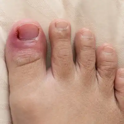 goolefootclinic-foot-treatment-OC