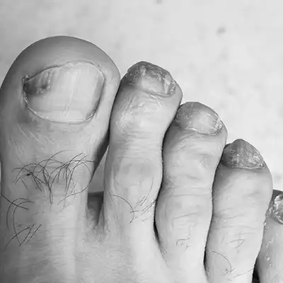 goolefootclinic-foot-treatment-OM-BW