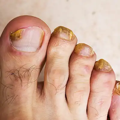 goolefootclinic-foot-treatment-OM
