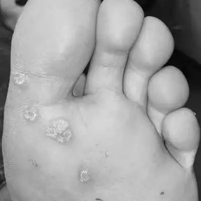 goolefootclinic-foot-treatment-VP-BW
