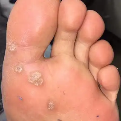 goolefootclinic-foot-treatment-VP